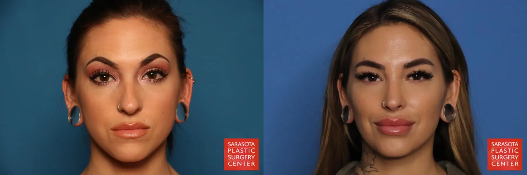 Rhinoplasty: Patient 35 - Before and After  