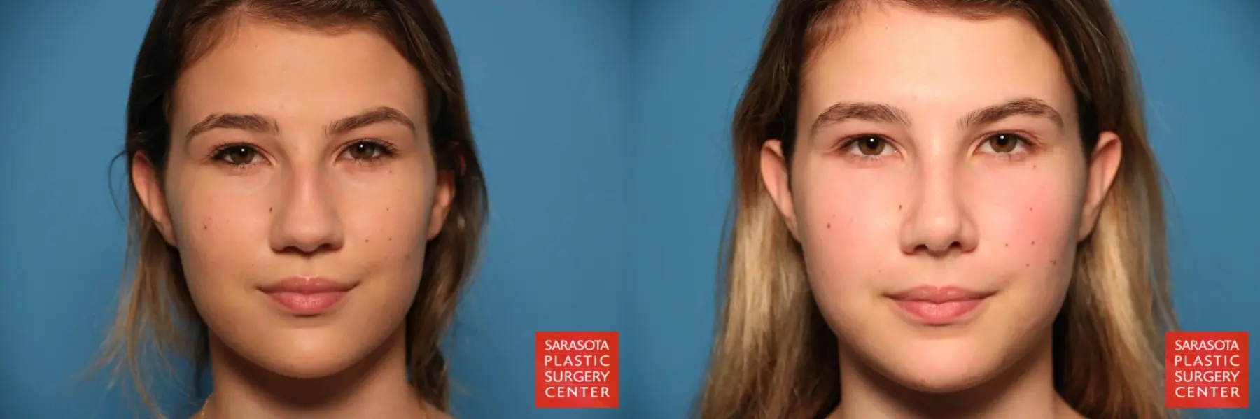 Rhinoplasty: Patient 25 - Before and After  