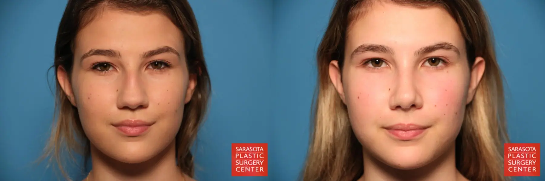 Rhinoplasty: Patient 24 - Before and After  