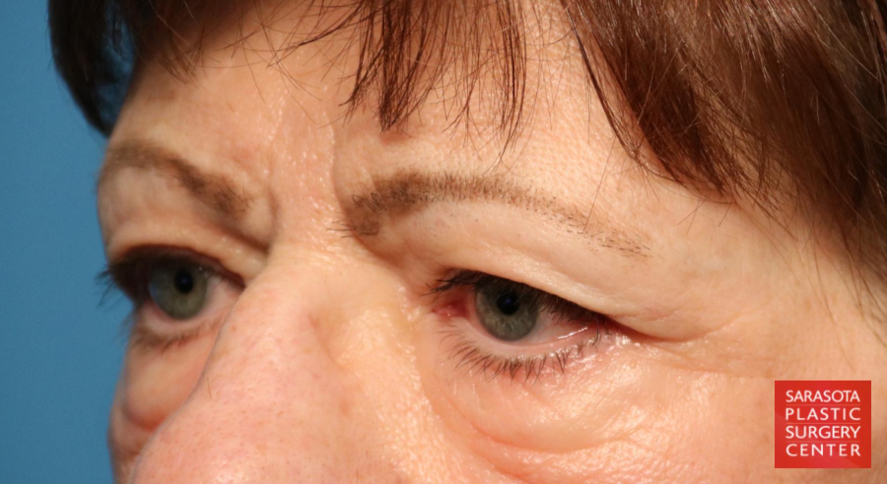 Blepharoplasty: Patient 15 - Before 4