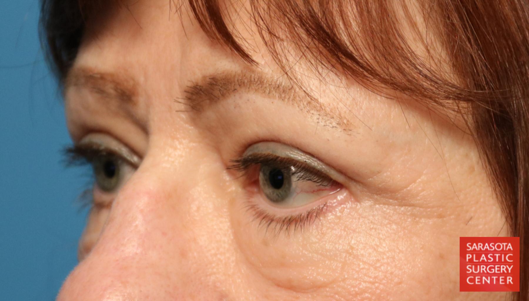 Blepharoplasty: Patient 15 - After 4