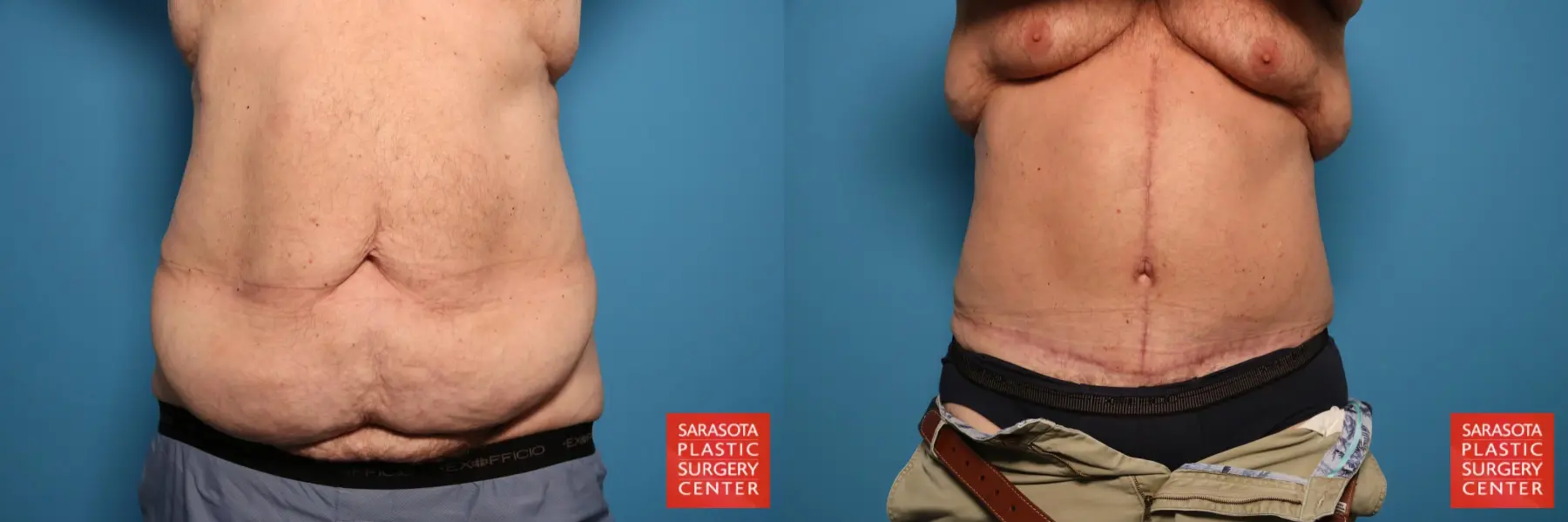 Tummy Tuck: Patient 49 - Before and After  