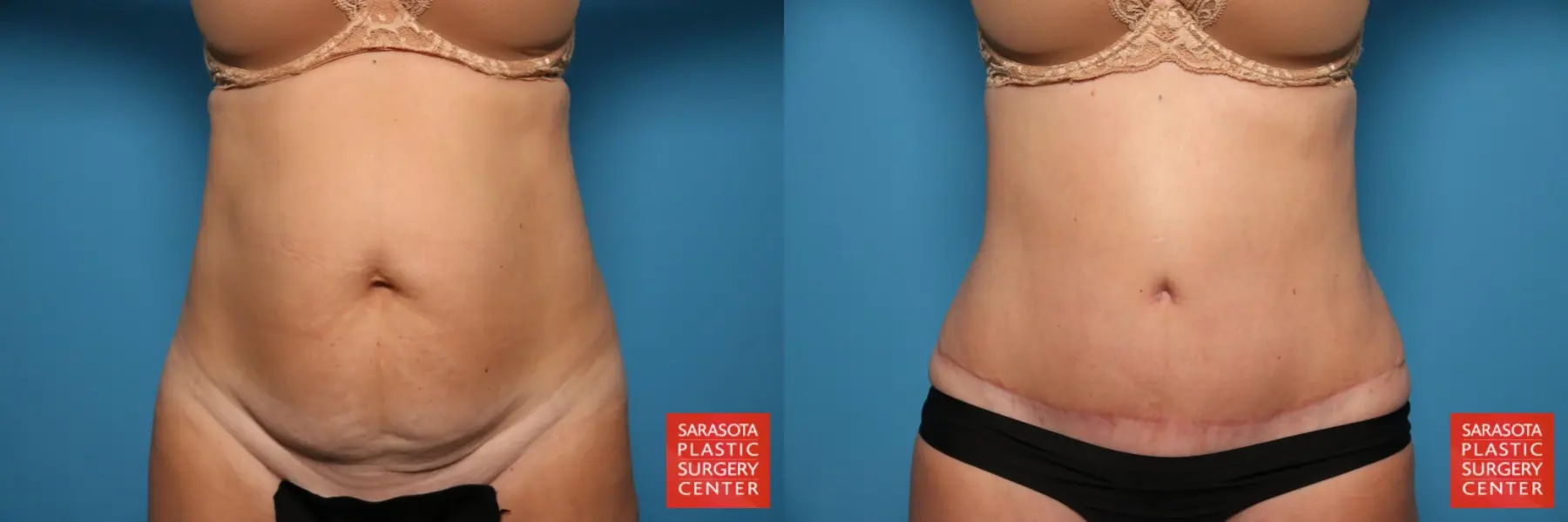 Tummy Tuck: Patient 5 - Before and After  