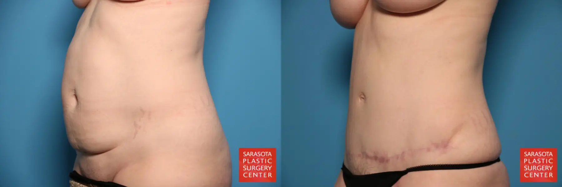 Tummy Tuck: Patient 18 - Before and After 2