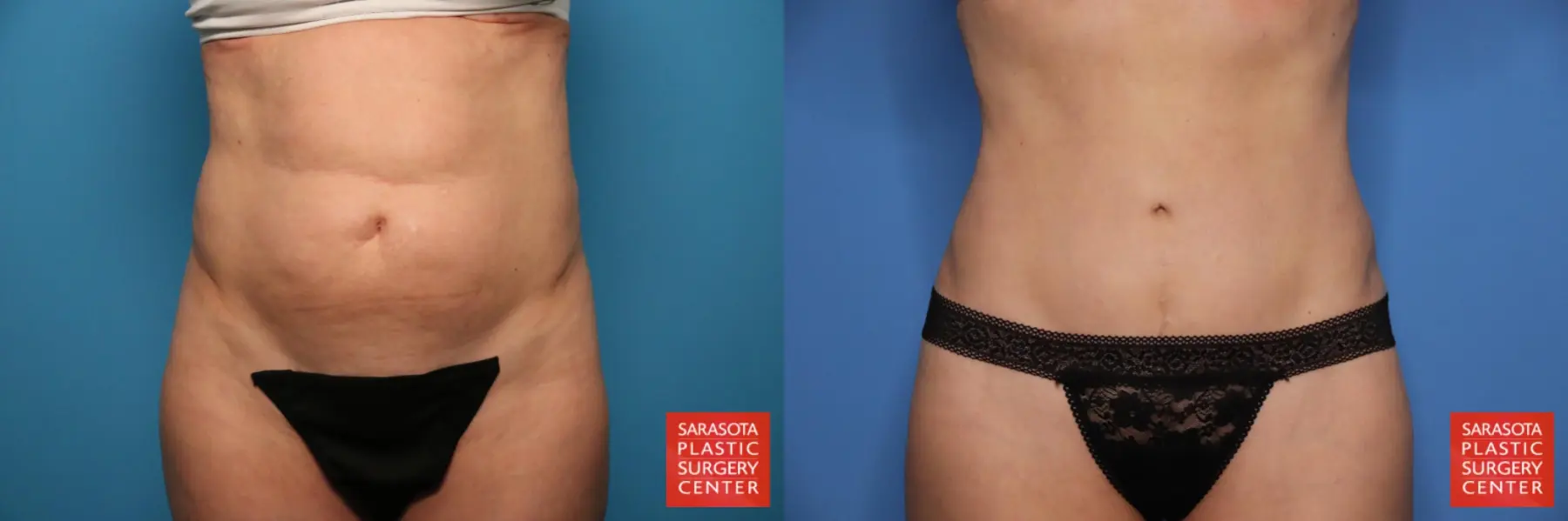 Tummy Tuck: Patient 29 - Before and After  