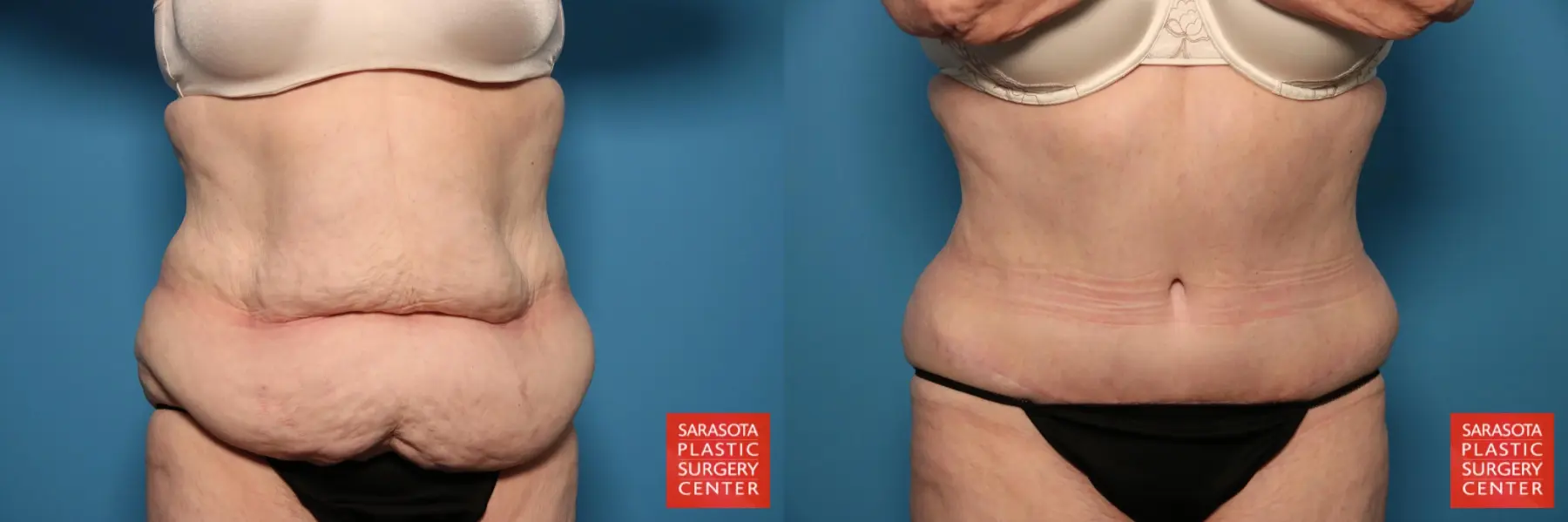 Tummy Tuck: Patient 35 - Before and After  