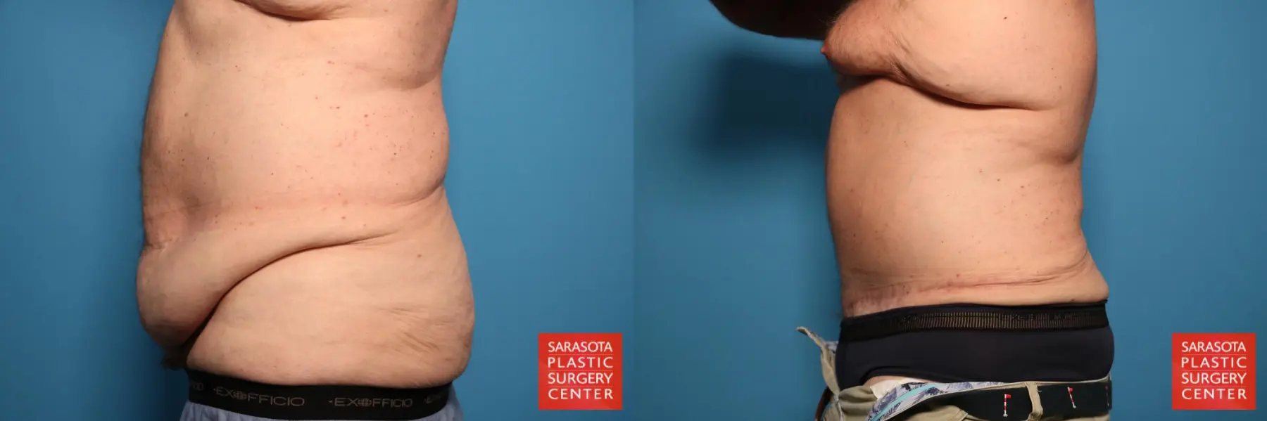 Tummy Tuck: Patient 49 - Before and After 3