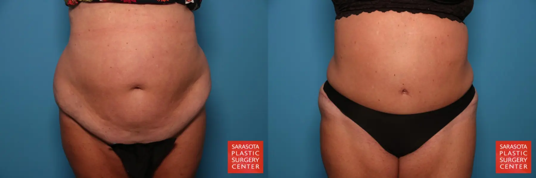 Tummy Tuck: Patient 71 - Before and After  