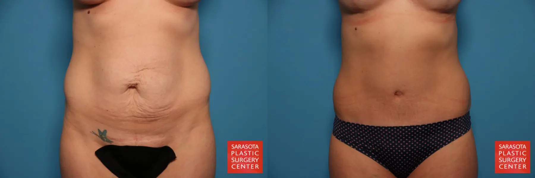 Tummy Tuck: Patient 16 - Before and After  