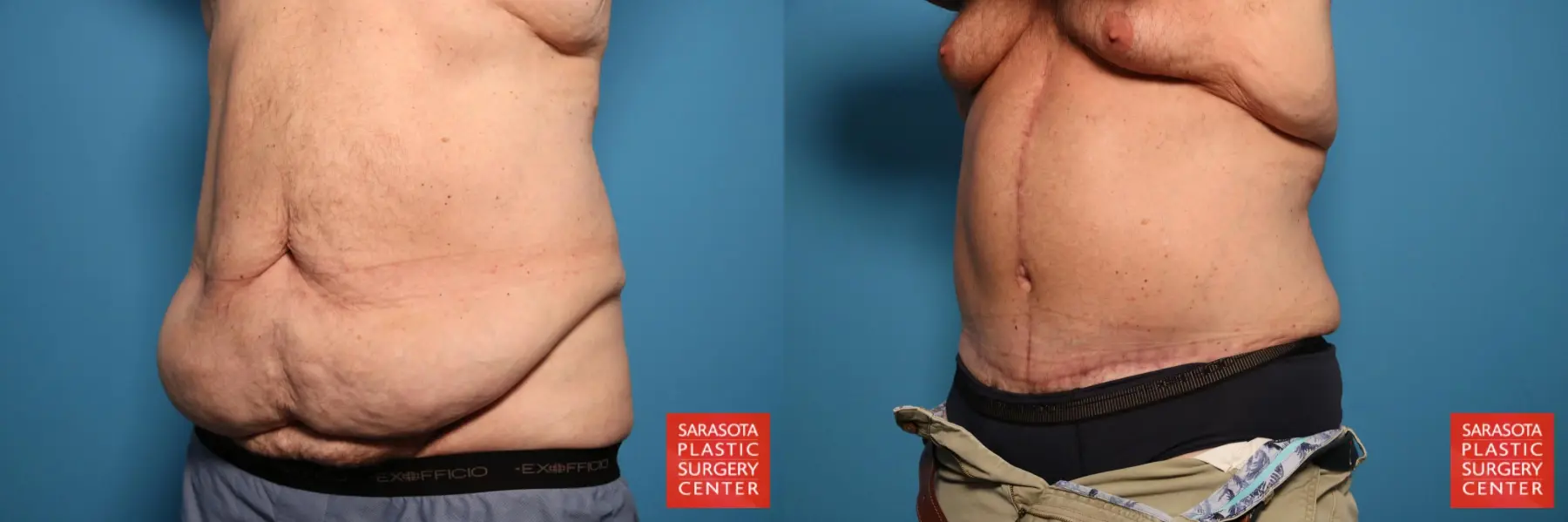 Tummy Tuck: Patient 49 - Before and After 2