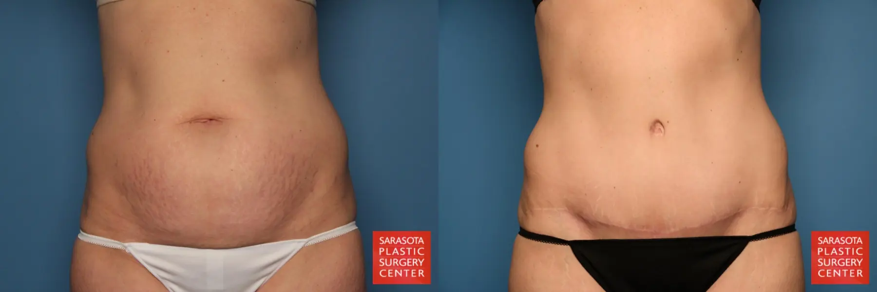 Tummy Tuck: Patient 1 - Before and After  