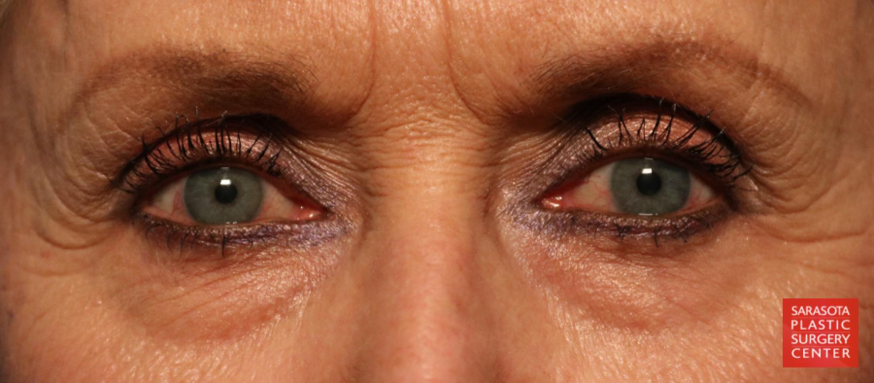 Blepharoplasty: Patient 20 - Before 
