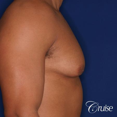 26 yo athletic patient with moderate gynecomastia - Before and After Image 3