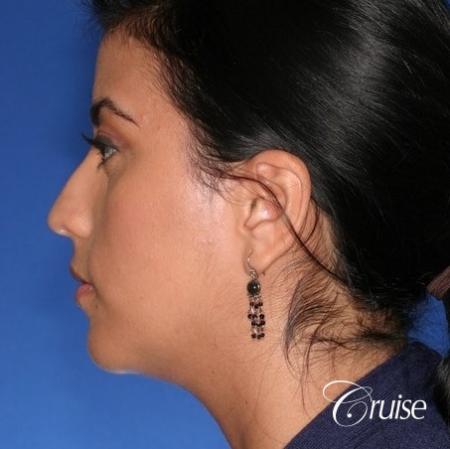 best XL chin implant on female patient - After Image 2