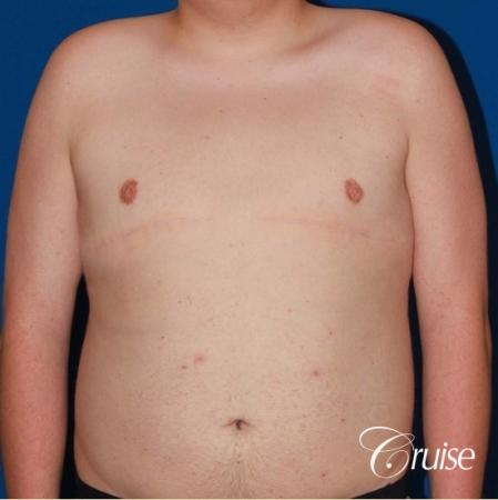 moderate gynecomastia with free nipple graft scar on teenager - After Image 1