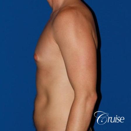 puffy nipple on low body fat - Before Image 2