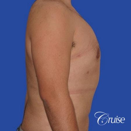 moderate gynecomastia with pointy nipples male - After Image 4