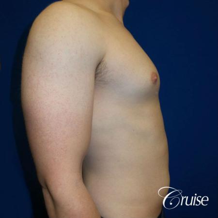 Adult gynecomastia before and after photos - Before and After Image 3