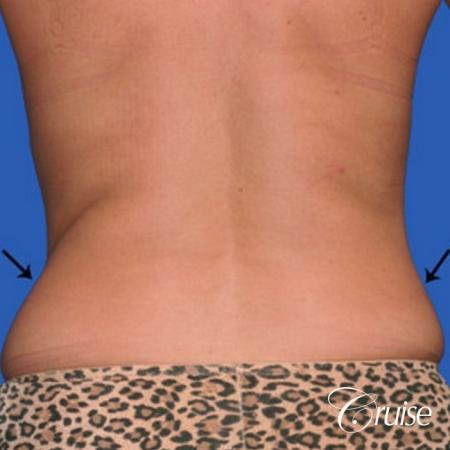 best lipo photos of love handles and stomach - Before and After Image 2