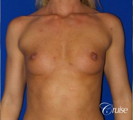 Breast Augmentation - Before Image 1