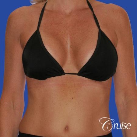 breast lift anchor with silicone implants on adult - After Image 4