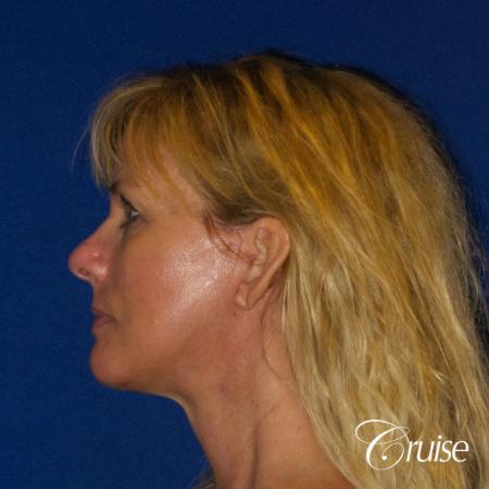 After Image 4