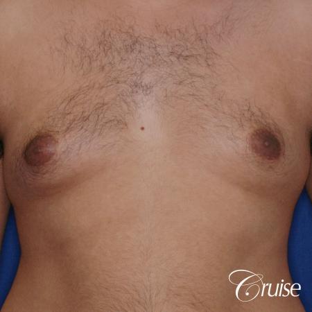 best scar on 32 gynecomastia patient - Before Image 1