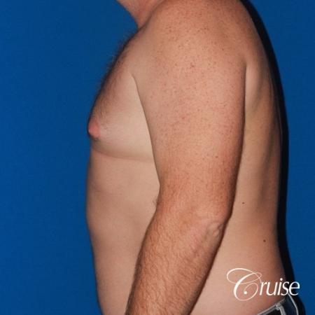 mild puffy nipple on 42 year old - Before Image 2