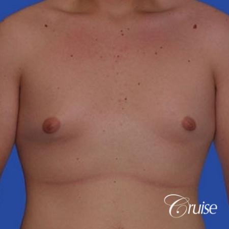 mild gynecomastia with puffy nipple from puberty - Before Image 1