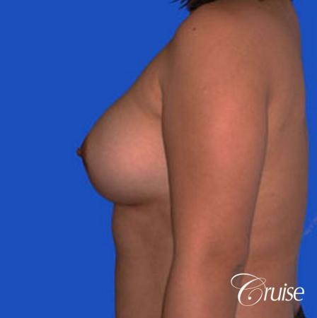 left breast capsular contracture before and after photos - After Image 2