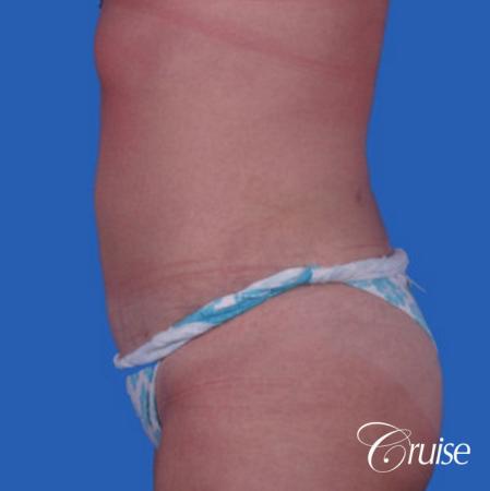 liposuction on abdomen photos - After Image 2