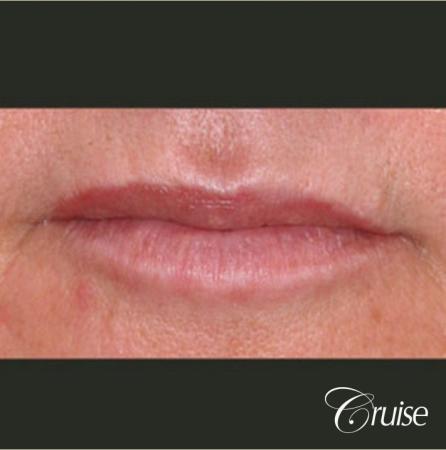 best filler pictures in Newport Beach - Before Image 1