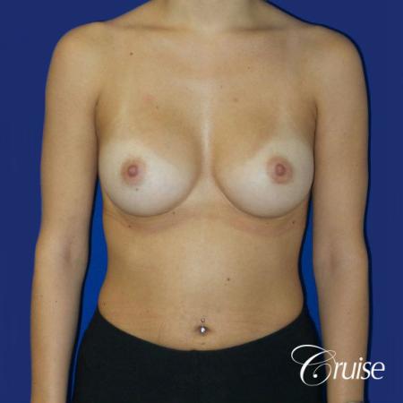 Breast Augmentation - After Image 1