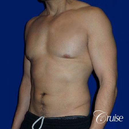 Moderate Gynecomastia -Pedicle - Before and After Image 3