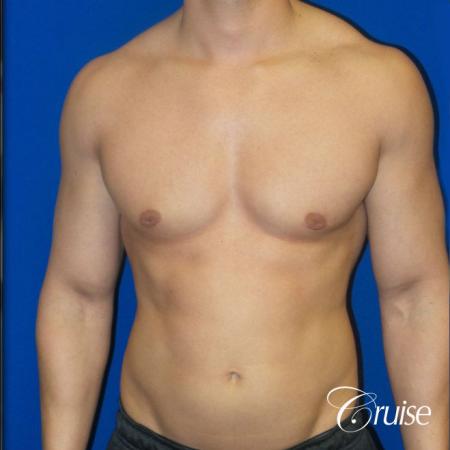 Best before and after gynecomastia pictures - After Image 1