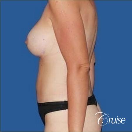 best mommy make over scars on massive weight loss silicone - After Image 2