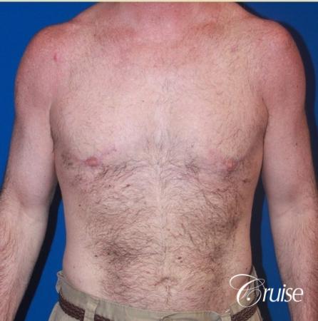 extended pa incision on gynecomastia patient - After Image 1