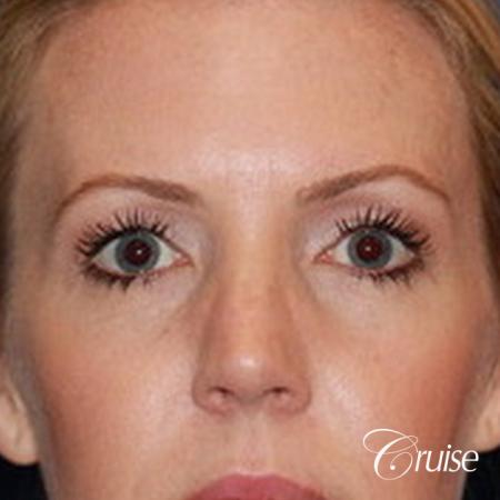 best upper eye lid results - Before Image 1