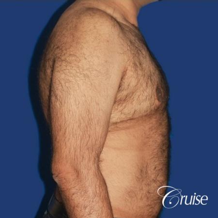 40 year old with severe gynecomastia results - After Image 3