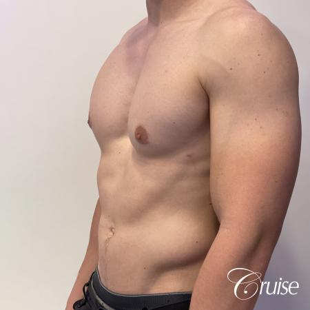 gynecomastia with puffy nipples - After Image 3