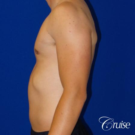 Best moderate gynecomastia on male adult - After Image 2