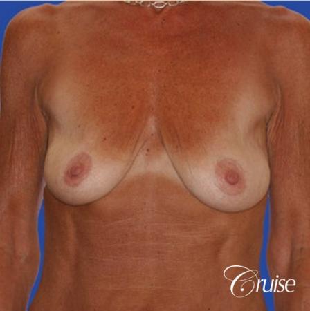 best results for breast lift in Orange County - Before Image 1