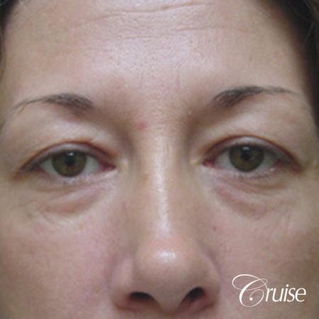 Fat Transfer - Lower Lids, Tear Trough - Before Image