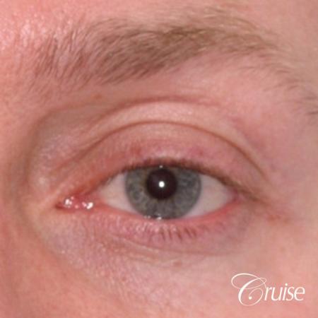 male soft tissue filler Juvaderm - Before Image 1