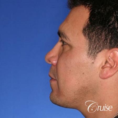 chin augmentation orange county - After Image 2
