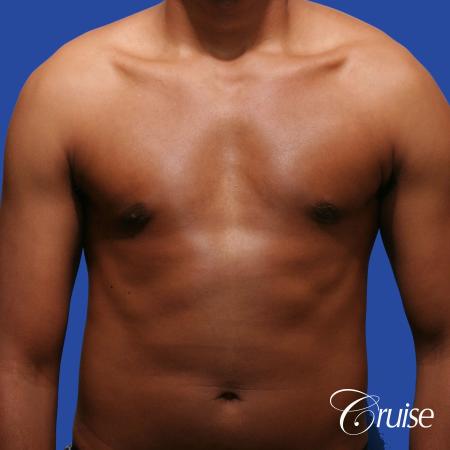 young body builder has puffy nipple and gets gynecomastia surgery - After Image 1