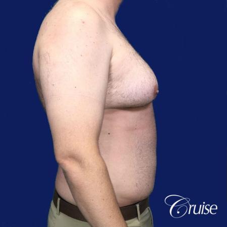 Severe Gynecomastia- Free nipple Graft - Before Image 2