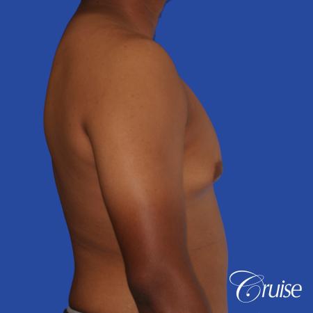 24 yr. old gets gynecomastia surgery with best scars - Before and After Image 3