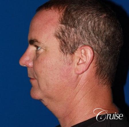 best pictures of chin augmentation with specialist - Before Image 2
