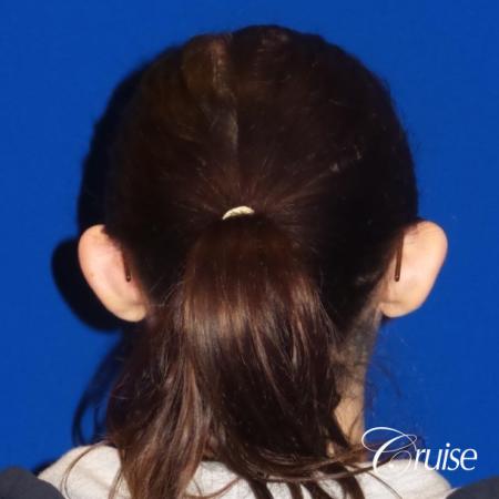 Otoplasty And Earlobe Repair: Patient 2 - Before Image 2